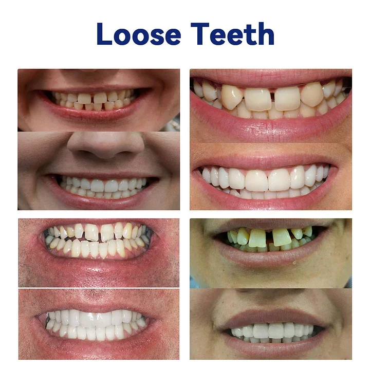 NESLEMY-🦷Advanced Customized Full Denture Set🦷
